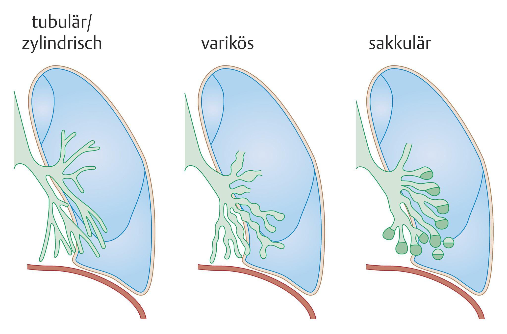 Abb.75.1-Einteilung-der-Bronchiektasen-nach-Reid