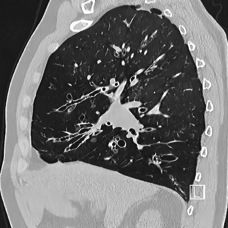 Abb.75.3-Bronchiektasen-in-der-hochaufgelösten-CT-Aufnahme(HRCT)